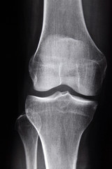front right knee radiograph