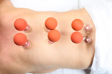 Schröpftherapie