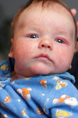 Baby has eczema
