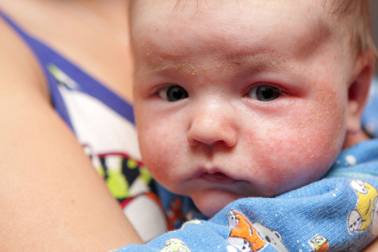 Eczema on face of newborn