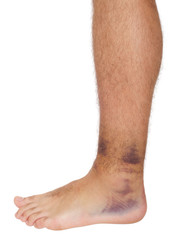 Ankle sprain