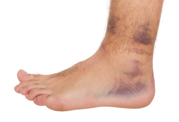 Ankle Sprain - 32665044