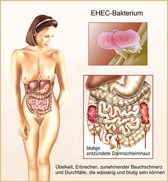 EHEC-Infektion.Bakterium.Darmentzuendung
