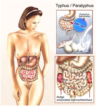 Typhus.Magen-Darm-Infektion.Verdauung