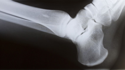 human foot ankle closeup and xray picture
