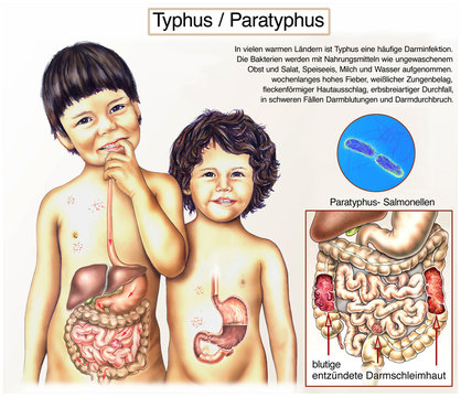 Typhus.Magen-Darminfektion bei Kindern
