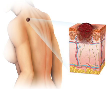 Melanoma De Piel En La Espalda