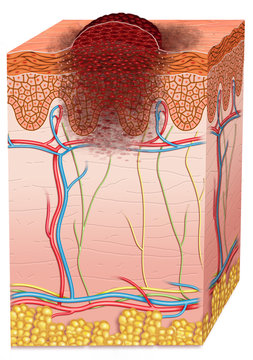 Esquema descriptivo de un C&aacute;ncer de piel tipo melanoma