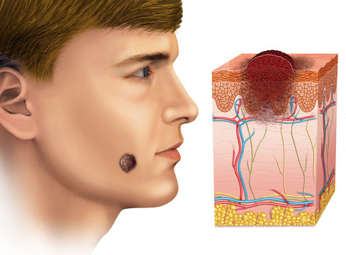 C&aacute;ncer de piel tipo melanoma.