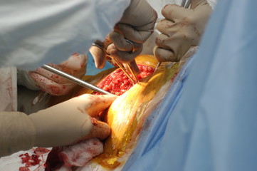 руки хирургов во время операции