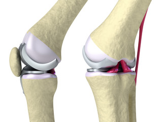 Knee and titanium hinge joint. Isolated on white