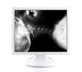 x-ray image and computer, concept modern medical diagnoses