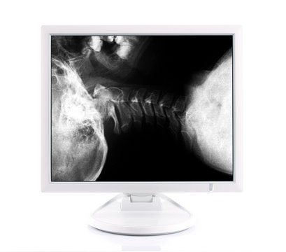 x-ray image and computer, concept modern medical diagnoses
