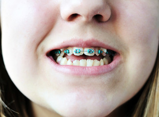 braces on bad crooked teeth