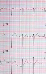 électrocardiogramme, graphique