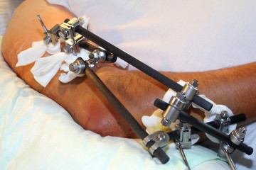 Biomechanik Chirurgie Patient mit Operation Fraktur am Arm mit Fixateur Externe
