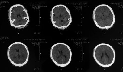 MRI tomogram of human brain