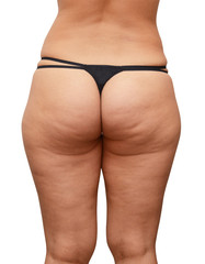 cellulite buttocks