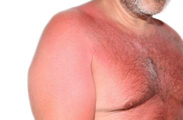 Naklejka premium Sonnenbrand