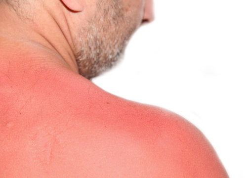 Sonnenbrand