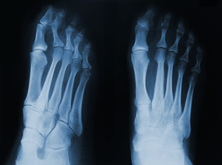 X-ray