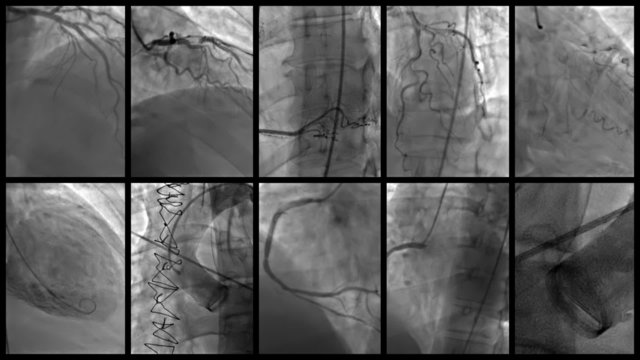 Cardiac Catheterization Mosaic