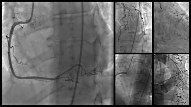 Cardiac Catheterization Mosaic