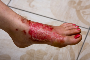 Burn feet