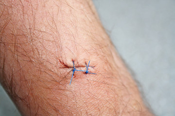 arm after a biopsy