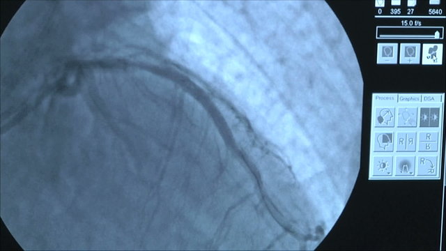 операция на сердце , рентген на мониторе