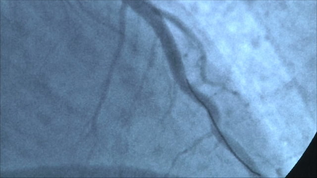 операция на сердце , рентген