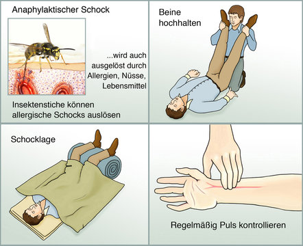 Anaphylaktischer Schock.Erste Hilfe