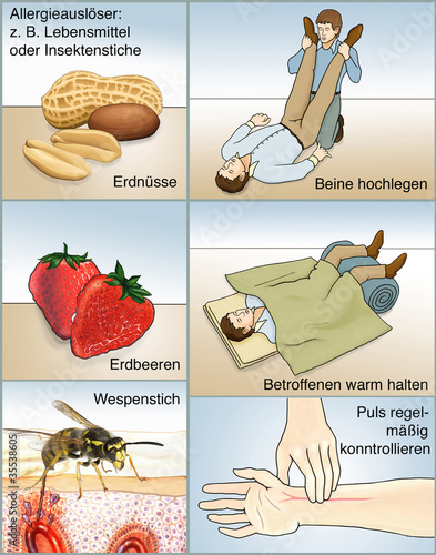 "Allergischer Schock.Auslöser.Erste Hilfe" Stockfotos und lizenzfreie