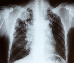 Chest x-ray