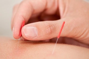 Acupuncture Macro