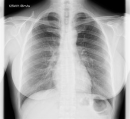 A chest x-ray image for a medical diagnosis.