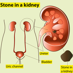 Stone in the kidney