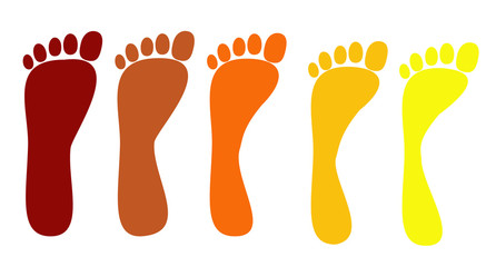 flat feet, various stages of the disease