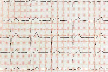 Electrocardiogram Result