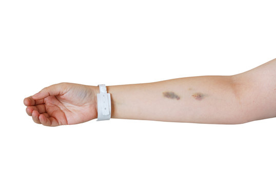 Arm with injection bruises and hospital wristband