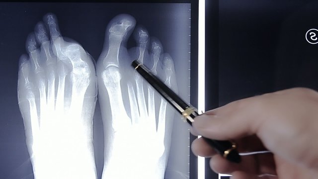 radiografia del piede