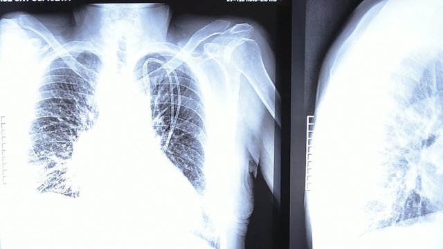 radiografia del torace