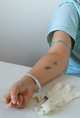 Arm with injection bruises on laboratory table