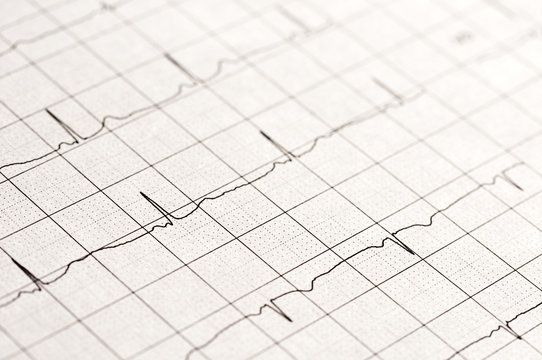 Electrocardiogramme normal