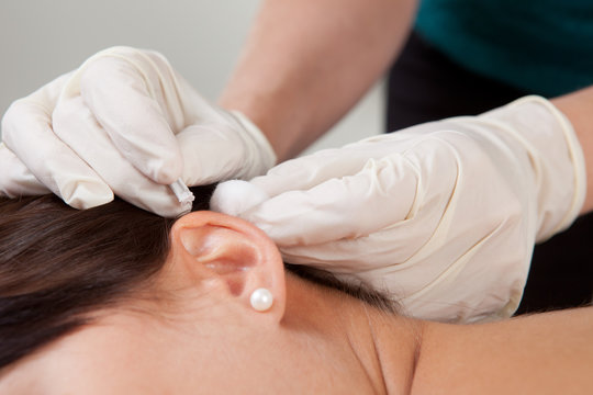 Auricular Acupuncture Treatment