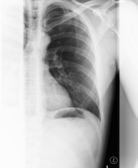 Röntgenbild Brustkorb