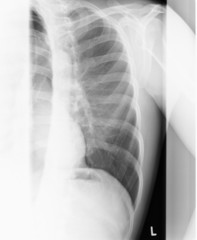 Röntgenbild Brustkorb - obrazy, fototapety, plakaty