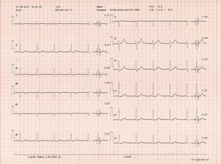 Electrocardiogramme