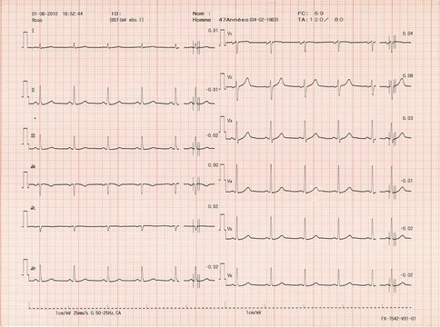 Electrocardiogramme