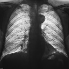 radiografia del torace negativa